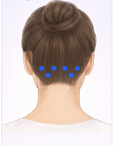 Diagram of greater and lesser occipital nerve block injection sites at the base of the skull