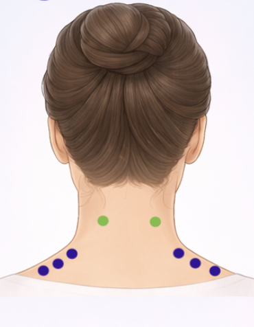 Diagram of trigger point injection sites in the cervical and shoulder muscles